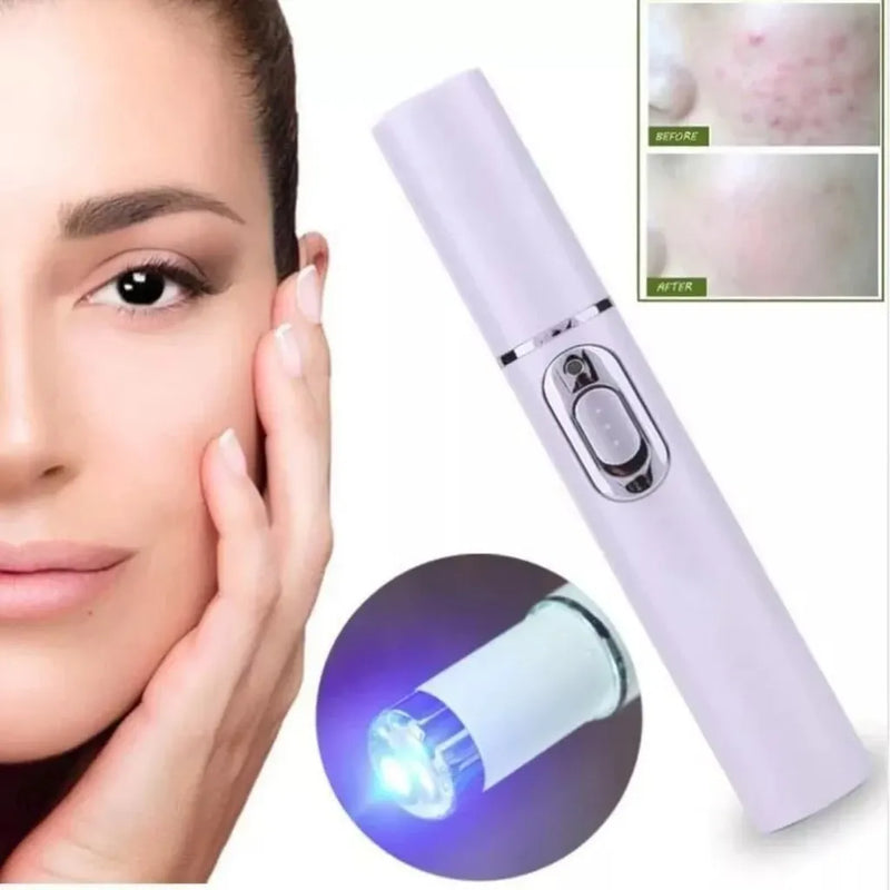 Caneta Laser Removedora de Varizes + Frete Grátis + Bônus + Descontos