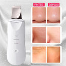 Peeling Facial UltraSkin com Limpeza Profunda e Rejuvenescimento Imediato